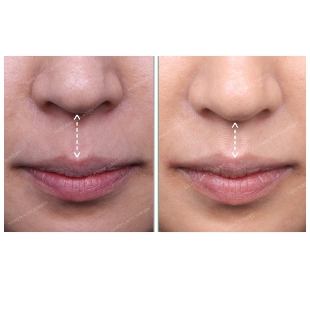 Resultados antes y después de lip lift en SAERO Plastic Surgery – contorno labial mejorado