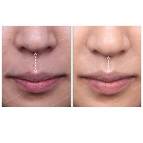 Результати до і після липліфтингу в SAERO Plastic Surgery – покращений контур верхньої губи