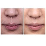 Результати до і після липліфтингу в SAERO Plastic Surgery – покращений контур верхньої губи
