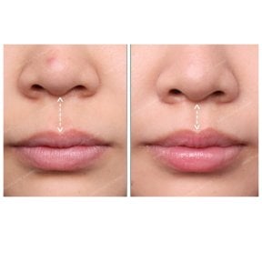 Результати до і після ліп ліфтингу в SAERO Plastic Surgery, покращений контур губ