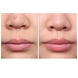 Результати до і після ліп ліфтингу в SAERO Plastic Surgery, покращений контур губ