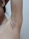 Подмышка после лазерной эпиляции в Yanhee International Hospital, гладкая кожа