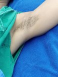 Подмышка до лазерной эпиляции в Yanhee International Hospital, виден рост волос