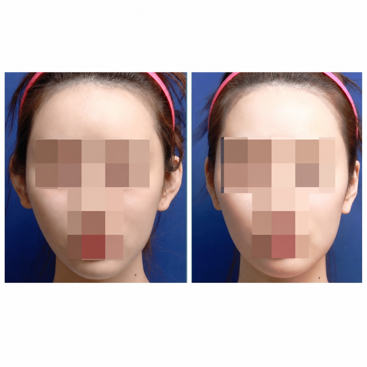 نتائج عملية تجميل الأذن قبل وبعد في SAERO Plastic Surgery، تحسين شكل وتناسق الأذنين