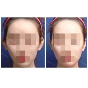 Результати отопластики до і після в SAERO Plastic Surgery, покращена форма та симетрія вух