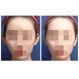 Результати отопластики до і після в SAERO Plastic Surgery, покращена форма та симетрія вух
