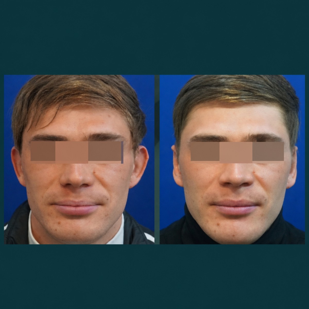 نتائج تجميل الأذن قبل وبعد في SAERO Plastic Surgery، تحسين شكل وأذن متناسقة