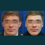 Результати отопластики до і після в SAERO Plastic Surgery, покращена форма і симетрія вух