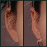 Результати отопластики до і після в SAERO Plastic Surgery, покращення форми вуха