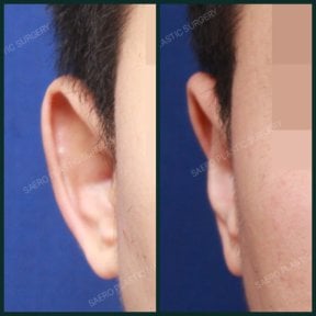 Результати отопластики до і після в SAERO Plastic Surgery, покращення форми вуха