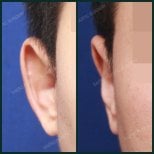 Результати отопластики до і після в SAERO Plastic Surgery, покращення форми вуха