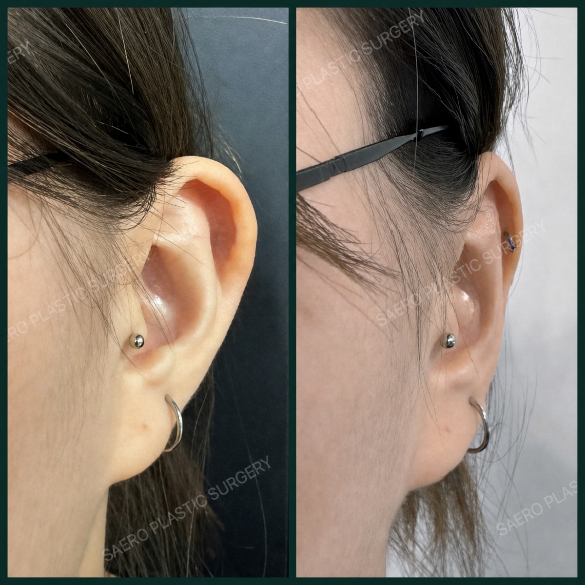 نتائج عملية تجميل الأذن قبل وبعد في SAERO Plastic Surgery، تحسين شكل الأذن