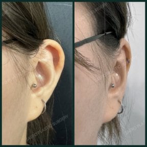 Результати отопластики до і після в SAERO Plastic Surgery, покращення форми вуха