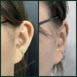 Результати отопластики до і після в SAERO Plastic Surgery, покращення форми вуха