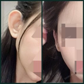Результати отопластики до і після в SAERO Plastic Surgery, покращення форми вуха