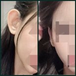 Результати отопластики до і після в SAERO Plastic Surgery, покращення форми вуха
