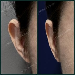 Результати отопластики до і після в SAERO Plastic Surgery, покращення форми вуха