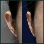 Результати отопластики до і після в SAERO Plastic Surgery, покращення форми вуха
