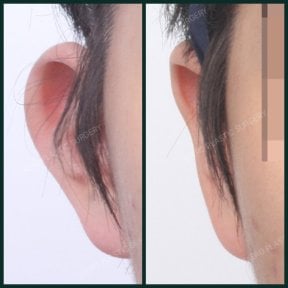 Результати отопластики до і після в SAERO Plastic Surgery, покращення форми вуха