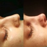 Before and after rhinoplasty results at Optimed International, improved nose profile