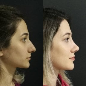 Before and after rhinoplasty results at Optimed International, improved nose profile