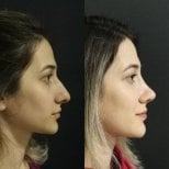 Before and after rhinoplasty results at Optimed International, improved nose profile
