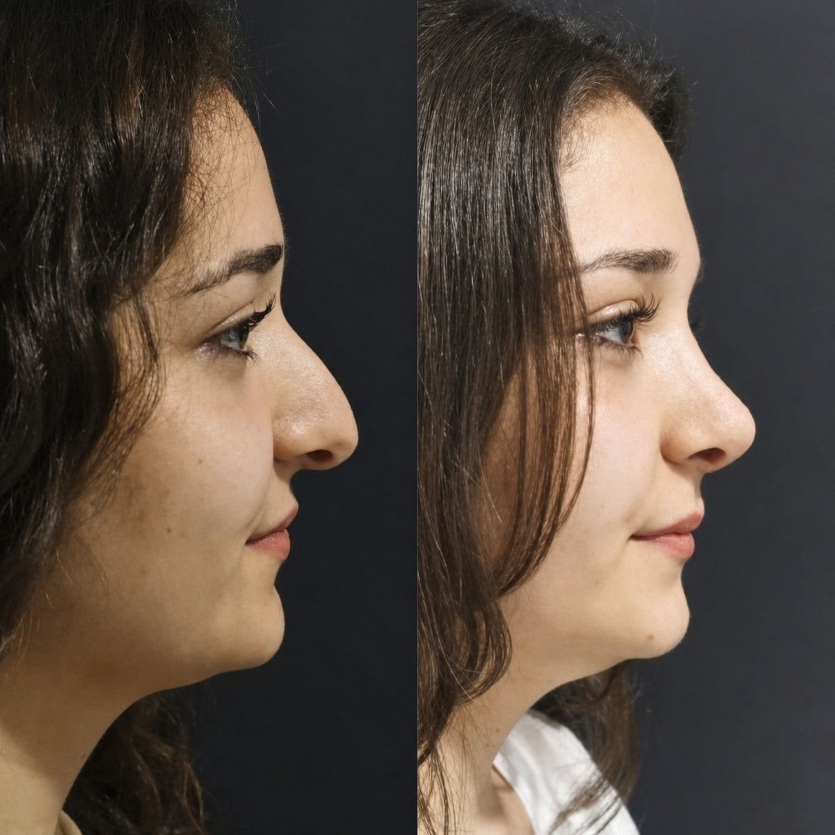 نتيجة عملية تجميل الأنف قبل وبعد في Optimed International، تحسين شكل الأنف الجانبي