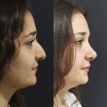 Before and after rhinoplasty result at Optimed International, improved nose profile