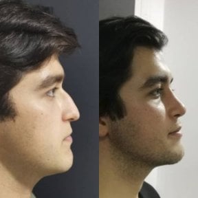 Before and after rhinoplasty results at Optimed International, improved nose profile