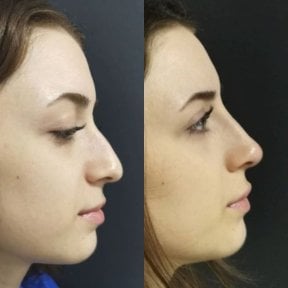 Before and after rhinoplasty results at Optimed International, improved nose shape profile