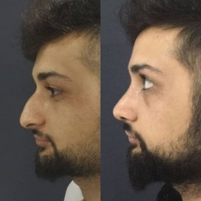 Before and after rhinoplasty results at Optimed International, improved nose shape profile