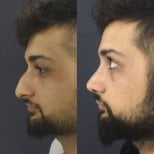 Before and after rhinoplasty results at Optimed International, improved nose shape profile