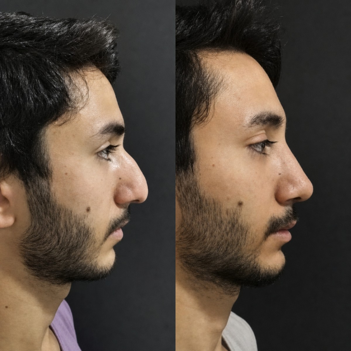 نتائج تجميل الأنف قبل وبعد في Optimed International، تحسين شكل الأنف للرجال