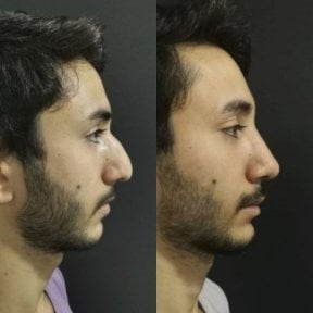Before and after rhinoplasty results at Optimed International, improved nose profile for men