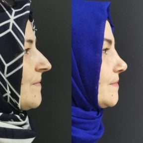 Before and after rhinoplasty result at Optimed International, improved nose profile