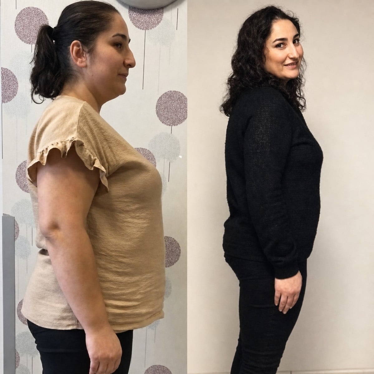 Antes y después de manga gástrica en Optimed International – resultado visible de pérdida de peso