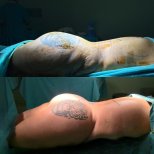 Результаты до и после Brazilian Butt Lift в Optimed International – улучшенный контур