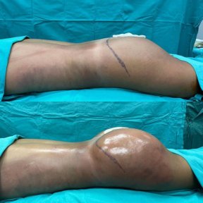 Результаты до и после Brazilian Butt Lift в Optimed International – улучшенный контур ягодиц