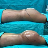 Результаты до и после Brazilian Butt Lift в Optimed International – улучшенный контур ягодиц