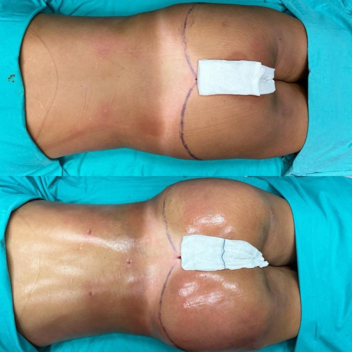 Resultados antes y después de Brazilian Butt Lift en Optimed International – glúteos realzados
