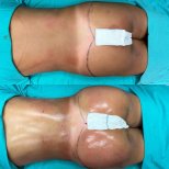 Результаты до и после Brazilian Butt Lift в Optimed International – улучшенный контур ягодиц