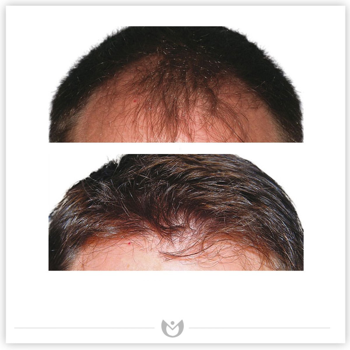 نتائج زراعة الشعر قبل وبعد في عيادة Klinika Elite – استعادة خط الشعر وكثافة أكبر