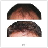 نتائج زراعة الشعر قبل وبعد في عيادة Klinika Elite – استعادة خط الشعر وكثافة أكبر