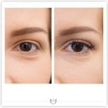 Before and after blepharoplasty results at Klinika Elite, eyelid correction for youthful eyes