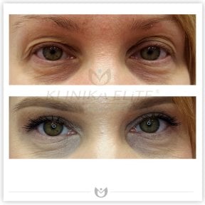 Before and after blepharoplasty results at Klinika Elite, eyelid correction for youthful eyes