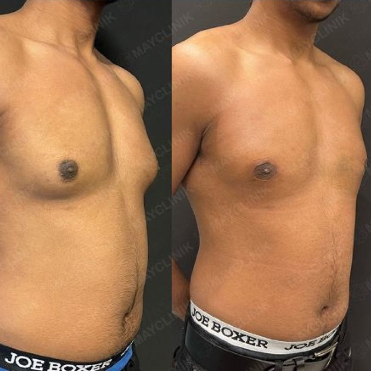 Resultados de liposucción antes y después en Hisar Hospital Intercontinental, mejor contorno torácico