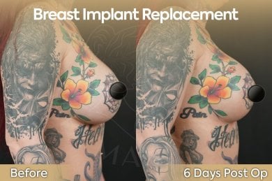 before-after photo mastopexy-breast-lift-contour-plastics