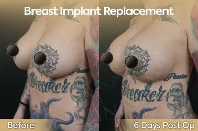 before-after photo mastopexy-breast-lift-contour-plastics