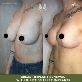 before-after photo mastopexy-breast-lift-contour-plastics