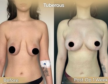 before-after photo mastopexy-breast-lift-contour-plastics